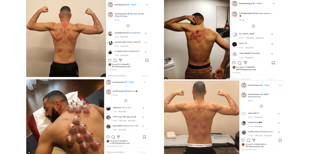 Cuatro fotos del Instagram de Benzema en las que aparecen las marcas causadas por el cupping