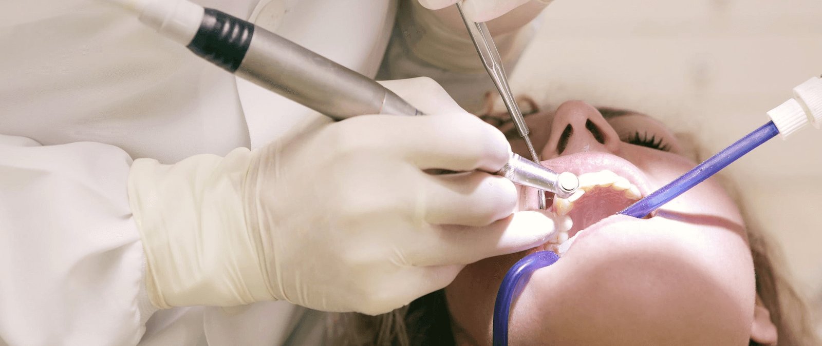 En qué casos se puede reimplantar un diente roto y por qué